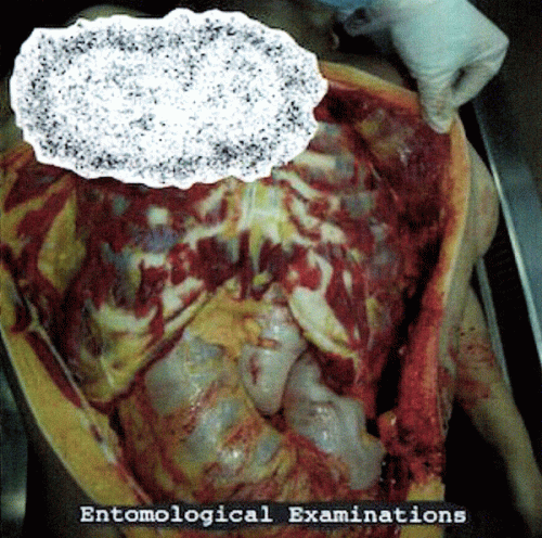 Hydroencephalocystocele : Entomological Examinations